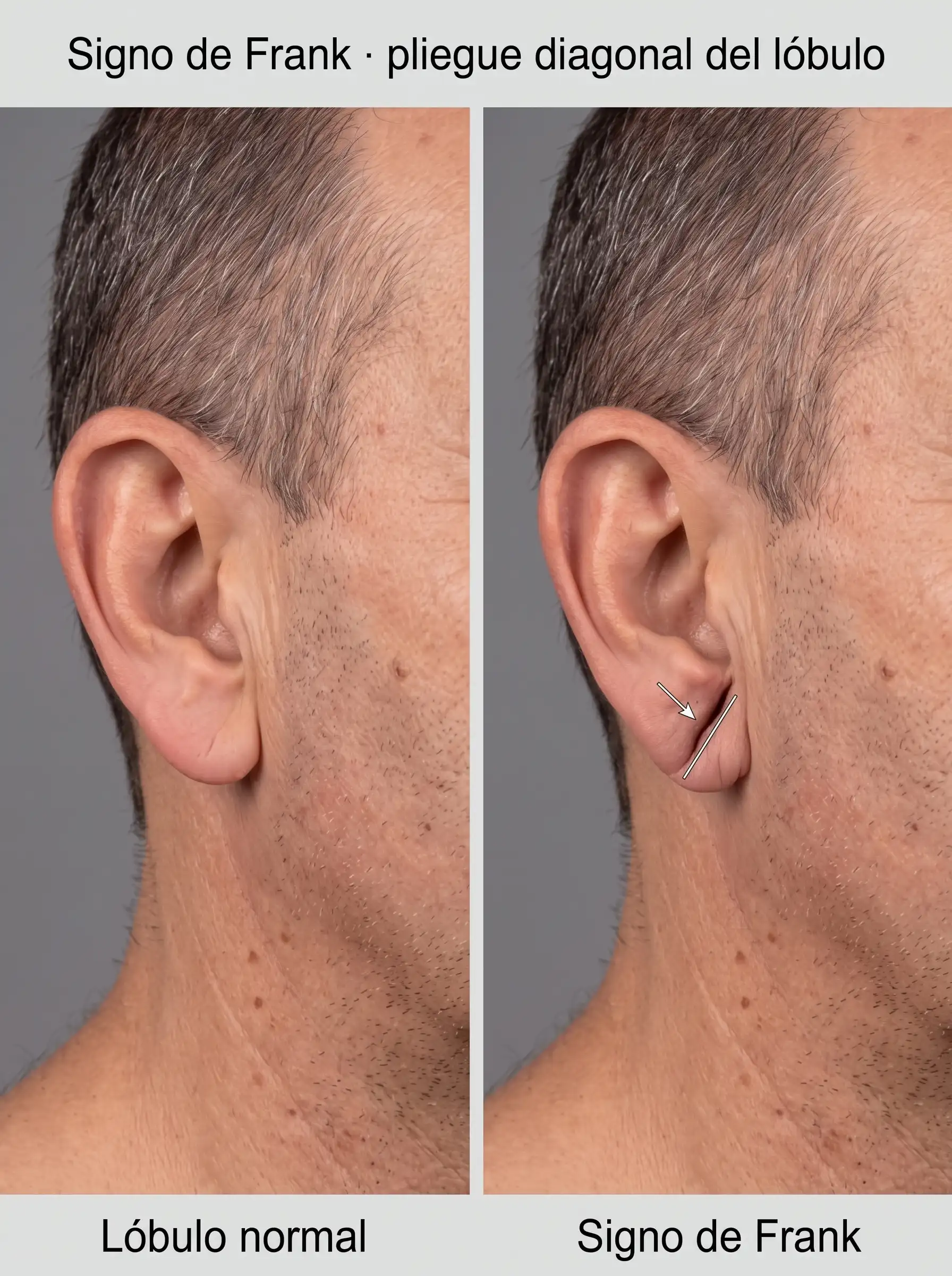 Signo de Frank en ilustraci&oacute;n comparativa: a la izquierda, un l&oacute;bulo de oreja sin pliegue que lo cruce; a la derecha, un pliegue diagonal incompleto en el l&oacute;bulo, se&ntilde;alado con una flecha.